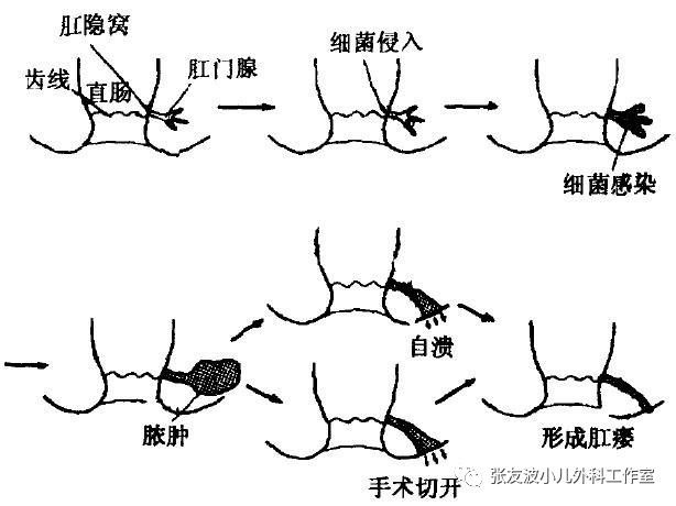 革新肛周脓肿治疗术，开启健康新篇章